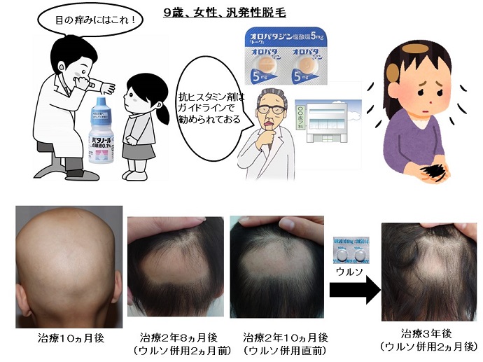 円形脱毛症　病院